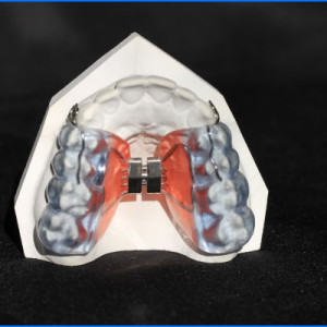 Haas-avec-coussin-occlusal