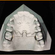 barre-transpalatine_2_AF